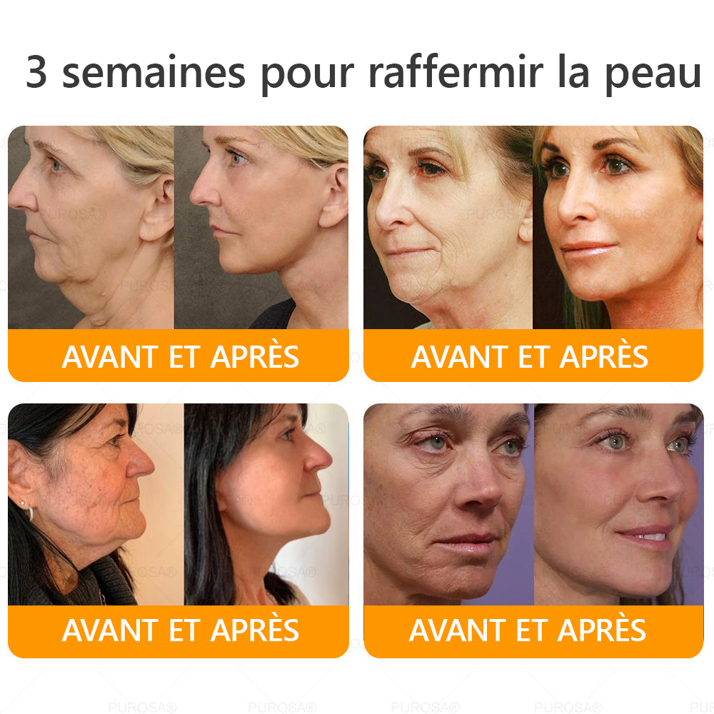 🐝🐝PUROSA® Venin d'abeille  Crème de restauration de la peau🔥 DERNIÈRE JOURNÉE – 80 % DE RABAIS !