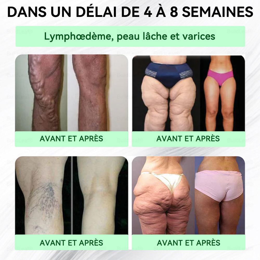 🏥Boutique officielle | Patch nano-microneedles GLP-1 BuildLeaf® avec collagène et Matrixyl 3000 – Ciblé pour l’obésité, les maladies cardiovasculaires, le diabète, l’apnée du sommeil, les problèmes articulaires et bien plus encore