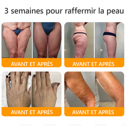 🐝🐝PUROSA® Venin d'abeille  Crème de restauration de la peau🔥 DERNIÈRE JOURNÉE – 80 % DE RABAIS !
